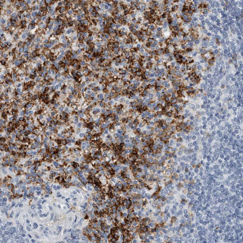 Immunohistochemical staining of human spleen shows strong membranous and cytoplasmic positivity in cells in red pulp.